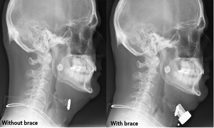 X-ray showing airway expansion with and without Corsomed brace